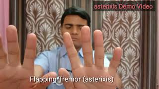 Asterixis Flapping tremor AKA  Hepatic encephalopathy [upl. by Lavro]