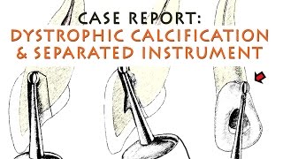 Dystrophic Calcification and Instrument removal [upl. by Cornia15]