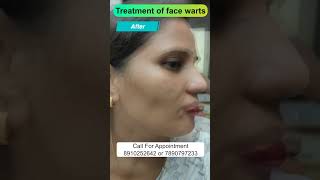 Treatment of face warts  By Dr Uttam Kumar Lenka MBBS MD Consultant Dermatologist [upl. by Merrick]