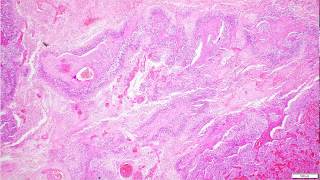 Glioblastoma IDH Wildtype Histopathological Diagnosis [upl. by Avera]