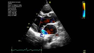 Echocardiographic assessment of the mitral valve [upl. by Lot]