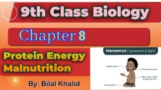 Protein Energy Malnutrition  Kwashiorkor amp Marasmus  Ch08  9th class Biology [upl. by Secnirp]