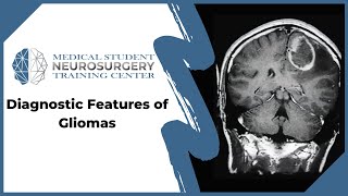 Diagnostic Features of Gliomas [upl. by Dene]