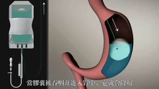 Elipse Intragastric Balloon [upl. by Noicpesnoc]