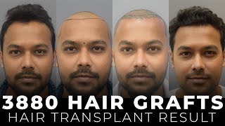 Shocking Before amp After Hair Restoration  Trichometric Sapphire FUE  Cara Clinic [upl. by Anihs263]