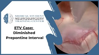 ETV Diminished Prepontine Interval [upl. by Leirua]