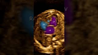 Fetal Ecocardiography Tricuspid atresia plus Ventricular septal defect [upl. by Aryajay]