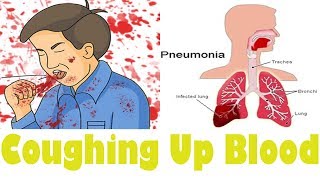 How to stop Blood up cough and Get more information Here [upl. by Oicanata385]