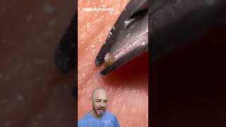 This ingrown hair removal is short and sweet credit blemishbandits on TT doctor satisfying [upl. by Cranston61]