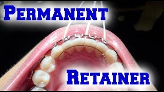 Braces Update Permanent Retainer [upl. by Pisano769]