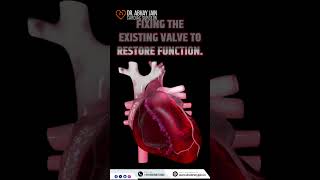 Mitral Valve Replacement amp Repair Essential for a healthy heart  Dr Abhay Jain [upl. by Eiroc]