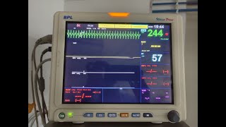 Treatment of PSVT by Inj Adenosine  demo of 2 syringe rapid flush technique [upl. by Humbert615]