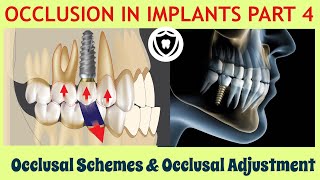 Occlusion in Implants Part 4 Occlusal schemes amp Occlusal adjustment [upl. by Nashbar]