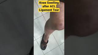 Knee Swelling ACL Ligament Tear  Knee Effusion aclsurgerykneeswelling ligamentinjurymbbsacl [upl. by Poll327]