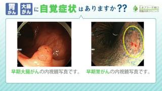 胃がん大腸がん自覚症状あるの？ [upl. by Oigile]