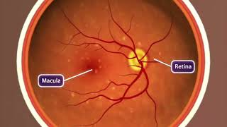 Animation Agerelated Macular Degeneration [upl. by Og]