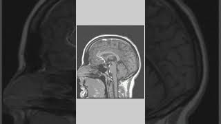 Mri Brain anotomy medicalstudent [upl. by Anecusa14]