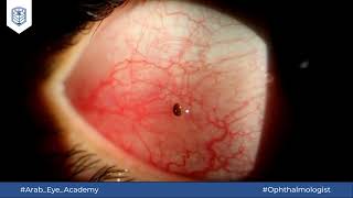 Educational Video 38 Conjunctival FB removal under slit lamp [upl. by Oleusnoc]