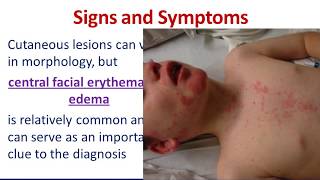 Dermatologic Emergencies 3 Drug Reaction with Eosinophilia and Systemic Symptoms DRESS SYNDROME [upl. by Modern]