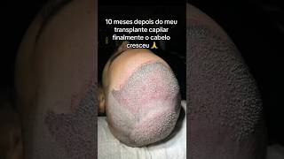 TRANSPLANTE CAPILAR ANTES E DEPOIS  10 meses transplantecapilar calvicie cabelo superação [upl. by Ocnarf915]