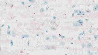 Cervix Low Grade Squamous Intraepithelial Lesion LSIL AutoCyte Histopathology  Madeformedicalcom [upl. by Tehr]