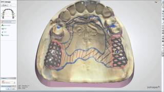 Dental System™ 2013  Removable Partial Design [upl. by Dorene]