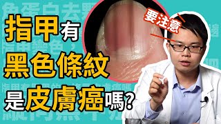 指甲有黑條紋，會是皮膚癌嗎？皮膚科楊省三醫師告訴你什麼是縱向黑甲症！ [upl. by Aloiv]