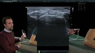 Elleboog  Common extensor tendon dwars  E14  echografie [upl. by Tanberg914]