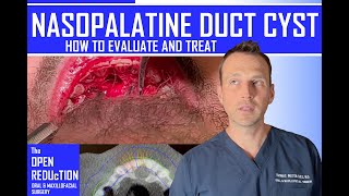 NASOPALATINE DUCT CYST REMOVAL [upl. by Adidnere]