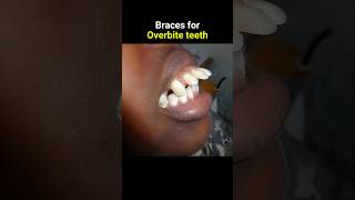 Braces overbite teeth braces orthodontist dentist teeth [upl. by Gridley]