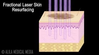 Co2 Laser Skin Resurfacing for Eyelids  Skin Tightening [upl. by Rabbi]