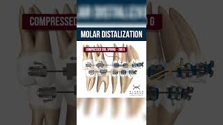 MOLAR DISTALIZATION  ORTHODONTIC TIPS Shorts [upl. by Nodnnarb]