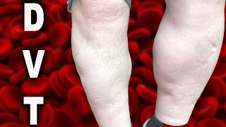 DVT Deep Venous Thrombosis in the leg [upl. by Ainehta]