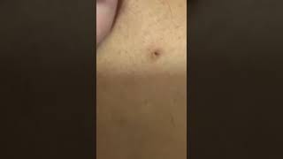 How to remove ingrown hairs [upl. by Yatzeck]