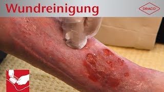 Wundreinigung Debridement bei chronischer Wunde  Verbandswechsel  DRACO [upl. by Cade]