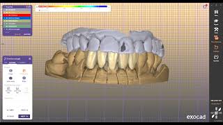 exocad exoplan 3shape codiagnostix blueskyplan millbox implastation 3Diagnosys b4d [upl. by Munsey]