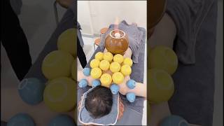 Cupping therapy process viral [upl. by Vanda970]