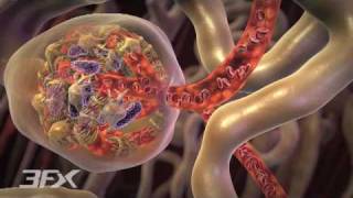 Diabetic Nephropathy [upl. by Zawde]