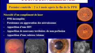 traitement au laser de la retinopathie Diabetique [upl. by Oir]