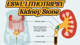 How to do Operation of Lithotripsy  ESWL Lithotripsy  Kidney Stone Treatment  Renal DJ Stent [upl. by Nus]