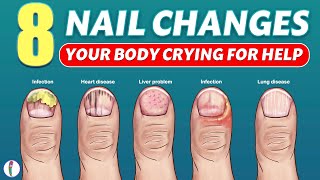 Nail signs of Disease  Nail pitting  Finger clubbing  Signs of anemia  Terrys nails [upl. by Aviv166]