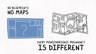 Monochorionic Twins Presentation [upl. by Schear997]