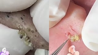 Ultimate ASMR Acne amp Blackhead Popping Compilation  Most Satisfying Extractions  Relaxation [upl. by Felicidad190]