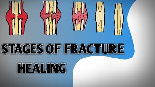 Stages of Fracture healing cortical and Cancellous bone in hindi amp English corticalbonehealing [upl. by Hjerpe264]