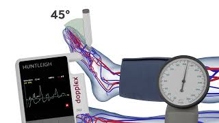 How to Measure the Systolic Pressure of the Dorsalis Pedis when Performing an ABPI [upl. by Blackmun883]