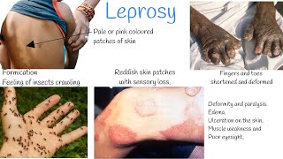 Leprosy signs and symptoms Treatment Hansens Disease [upl. by Watt]