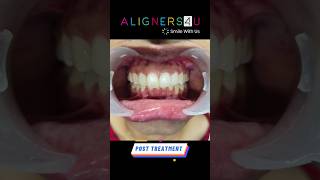 Teeth Straightening With Clear Aligners Treatment in Hyderabad  Aligners Braces  Smile Makeover [upl. by Irovi100]