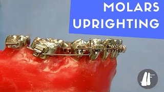 UPRIGHTING MOLARS [upl. by Perkins219]