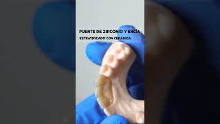 Puente de Zirconio estratificado con cerámica y cerámica de encíaimpresión dental 3d [upl. by Courcy675]