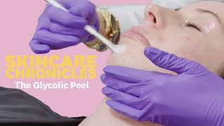 Should You Get a Chemical Peel for Acne  Skincare Chronicles  Womens Health [upl. by Oicafinob]